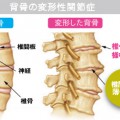 背骨の変形性関節症
